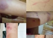 Misnawati Warga Luwu, Lapor ke Polsek Ponrang sebagai Korban Penganiayaan Malah jadi Pelaku Berujung Vonis Penjara 11 luka e1778055891876